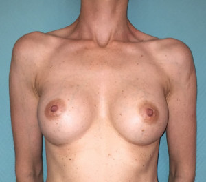 Augmentation mammaire 2