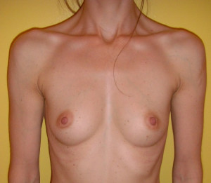 Augmentation mammaire1