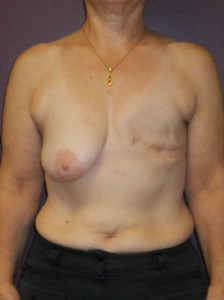 Reconstruction mammaire 1