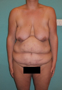chir de la silhouette bodylift1