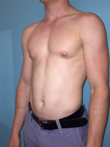 Gynecomastie 3