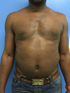 Gynecomastie 7